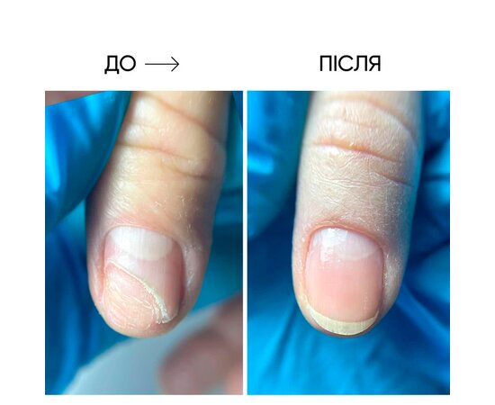 Изображение 6 Масло для ногтей и кожи Onistop Nails Of The Day (для лечения онихолизиса) 8 мл (S-ND), Объем (мл, г): 8