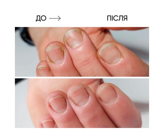 Изображение 5 Масло для ногтей и кожи Onistop Nails Of The Day (для лечения онихолизиса) 8 мл (S-ND), Объем (мл, г): 8