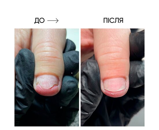 Изображение 4 Масло для ногтей и кожи Onistop Nails Of The Day (для лечения онихолизиса) 15 мл (S-ND), Объем (мл, г): 15